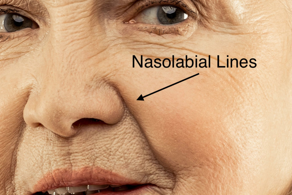 nasolabial lines